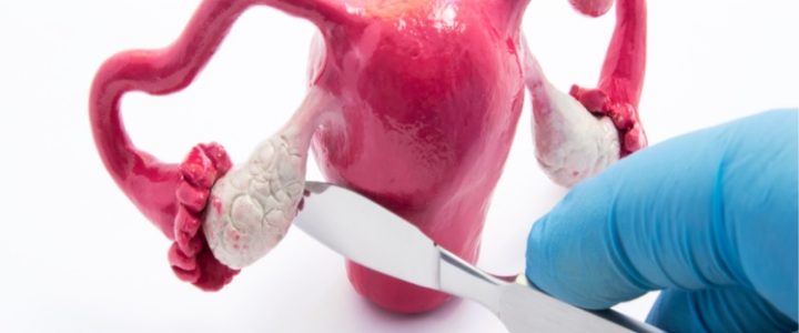 What is an Ovarian Cyst